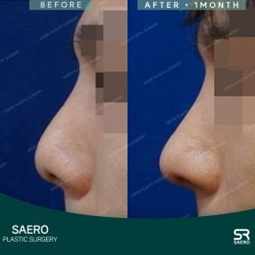 before-after photo rhinoplasty-nose-job