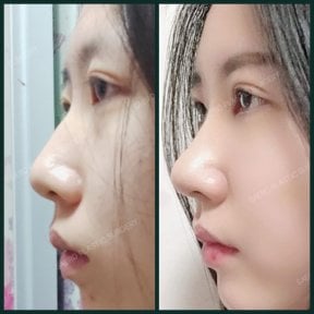 before-after photo rhinoplasty-nose-job