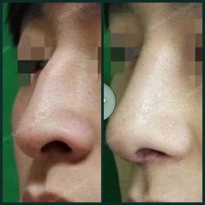 Before and after rhinoplasty results at SAERO Plastic Surgery, improved nose shape and contour