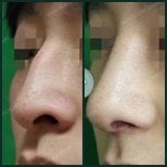 Before and after rhinoplasty results at SAERO Plastic Surgery, improved nose shape and contour