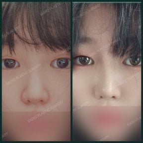 Before and after rhinoplasty results at SAERO Plastic Surgery, nose reshaping improvement