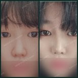 Before and after rhinoplasty results at SAERO Plastic Surgery, nose reshaping improvement