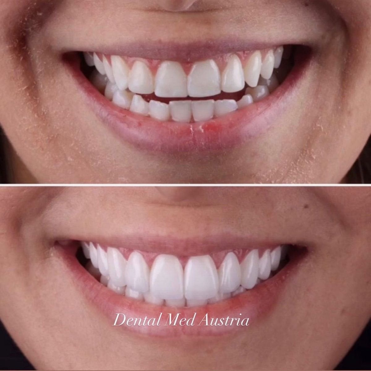 Resultado antes y después de carillas en Dental Med Austria & Elixence, transformación de sonrisa