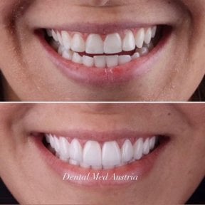 before-after photo installation-of-a-veneer