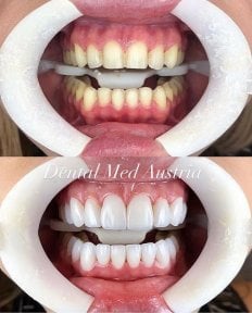before-after photo installation-of-a-veneer
