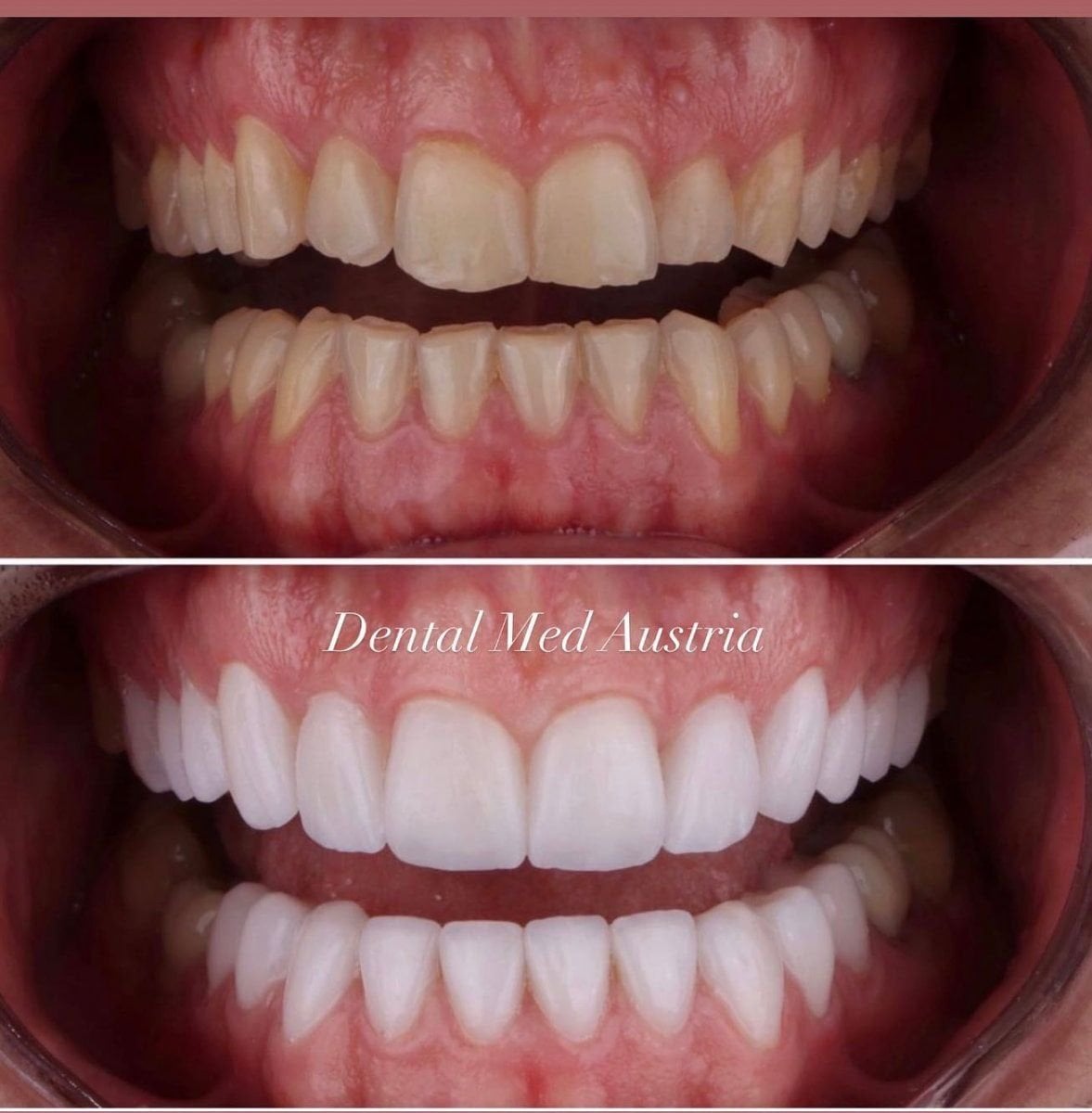 Antes y después de carillas en Dental Med Austria & Elixence – resultados de sonrisa transformada