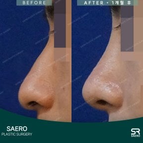 before-after photo rhinoplasty-nose-job