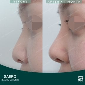 before-after photo rhinoplasty-nose-job