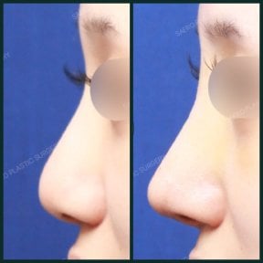 before-after photo rhinoplasty-nose-job