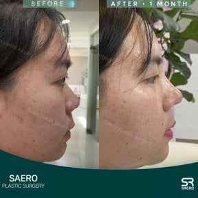 before-after photo rhinoplasty-nose-job