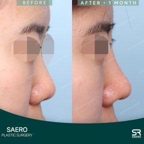 before-after photo rhinoplasty-nose-job