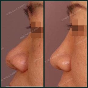 before-after photo rhinoplasty-nose-job