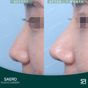 before-after photo rhinoplasty-nose-job