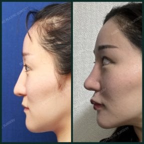 before-after photo rhinoplasty-nose-job