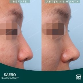 before-after photo rhinoplasty-nose-job