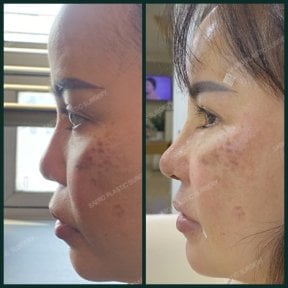 before-after photo rhinoplasty-nose-job
