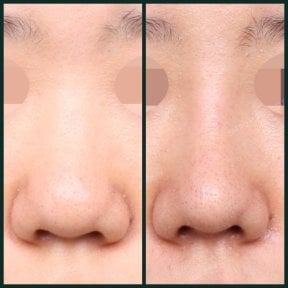 before-after photo rhinoplasty-nose-job