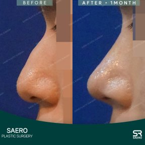 before-after photo osteotomy-rhinoplasty