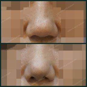 before-after photo osteotomy-rhinoplasty