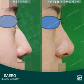 before-after photo osteotomy-rhinoplasty
