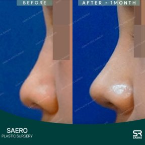 before-after photo osteotomy-rhinoplasty