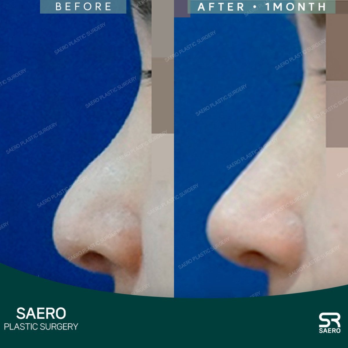 Resultados de rinoplastia con osteotomía antes y después en SAERO Plastic Surgery, perfil mejorado