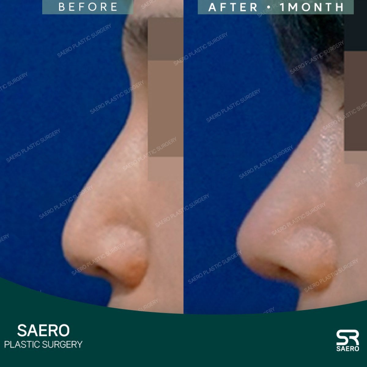 Resultados de rinoplastia con osteotomía antes y después en SAERO Plastic Surgery, perfil mejorado