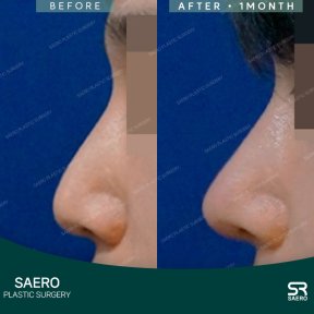 before-after photo osteotomy-rhinoplasty