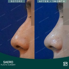 before-after photo osteotomy-rhinoplasty
