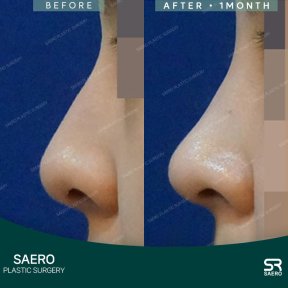 before-after photo osteotomy-rhinoplasty