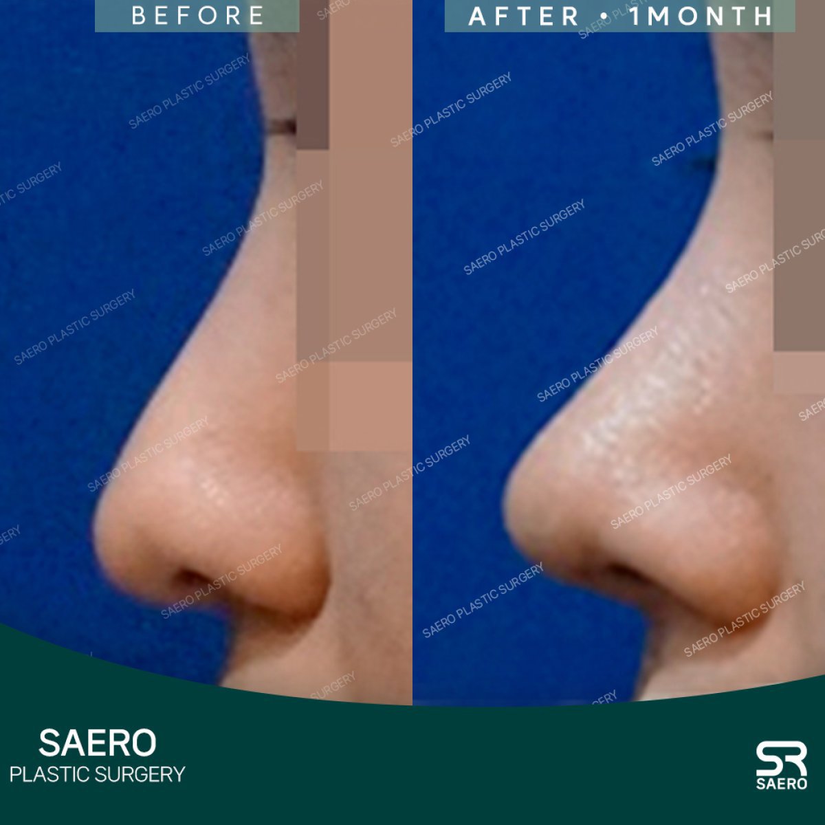 Resultados de rinoplastia con osteotomía antes y después en SAERO Plastic Surgery, perfil mejorado