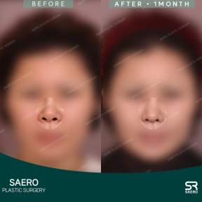 before-after photo osteotomy-rhinoplasty