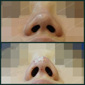 before-after photo osteotomy-rhinoplasty