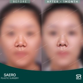 before-after photo osteotomy-rhinoplasty