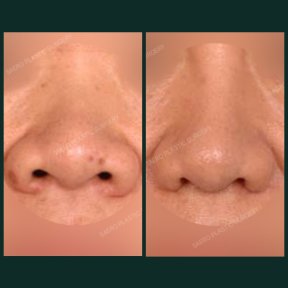 before-after photo osteotomy-rhinoplasty