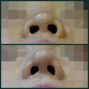 before-after photo osteotomy-rhinoplasty