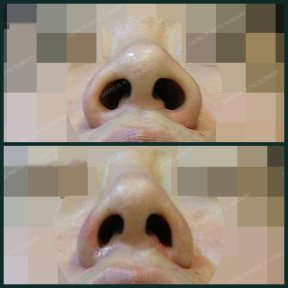 before-after photo osteotomy-rhinoplasty