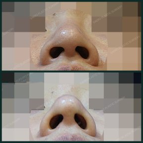before-after photo osteotomy-rhinoplasty