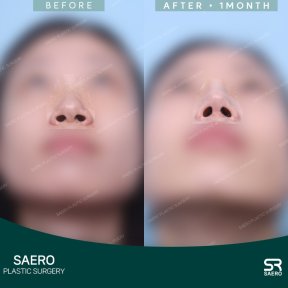 before-after photo osteotomy-rhinoplasty