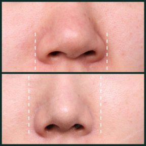 before-after photo osteotomy-rhinoplasty