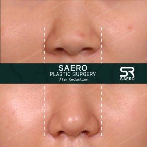 before-after photo osteotomy-rhinoplasty