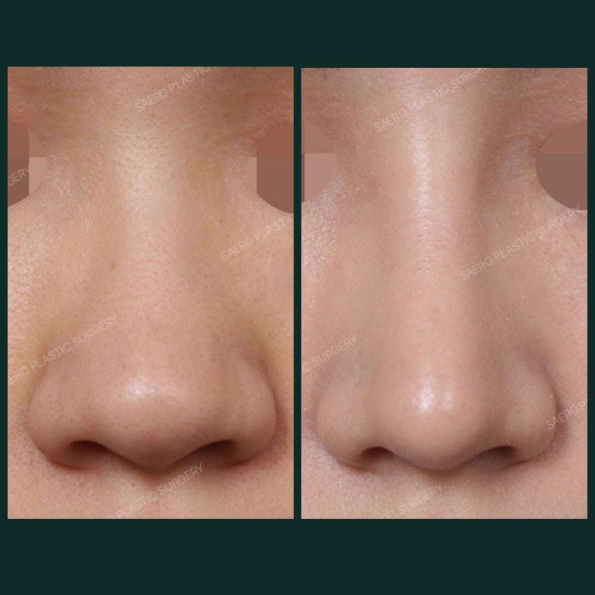 Resultados antes y después de alarplastia en SAERO Plastic Surgery, mejora de la forma nasal