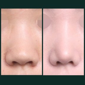 before-after photo alarplasty