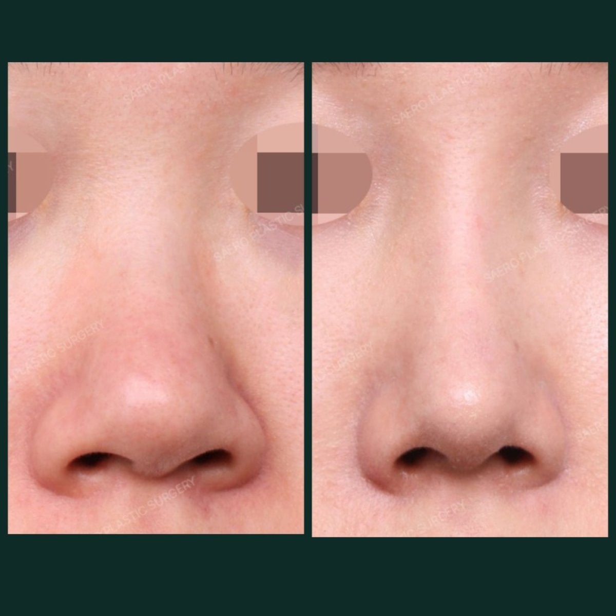 Resultados de alarplastia antes y después en SAERO Plastic Surgery, mejora de la forma nasal