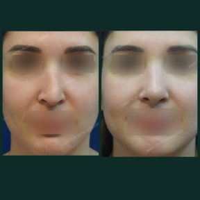 before-after photo alarplasty