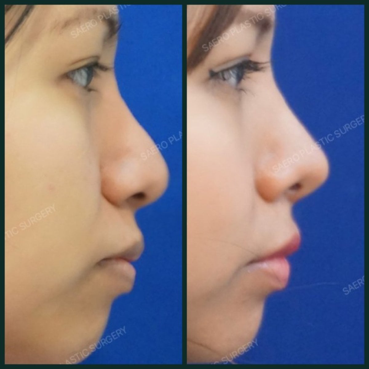 Resultados antes y después de alarplastia en SAERO Plastic Surgery, mejora de la forma nasal