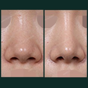 before-after photo alarplasty