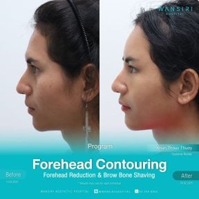 before-after photo rinoplastika-plastika-nosa