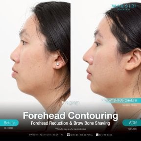 before-after photo rinoplastika-plastika-nosa