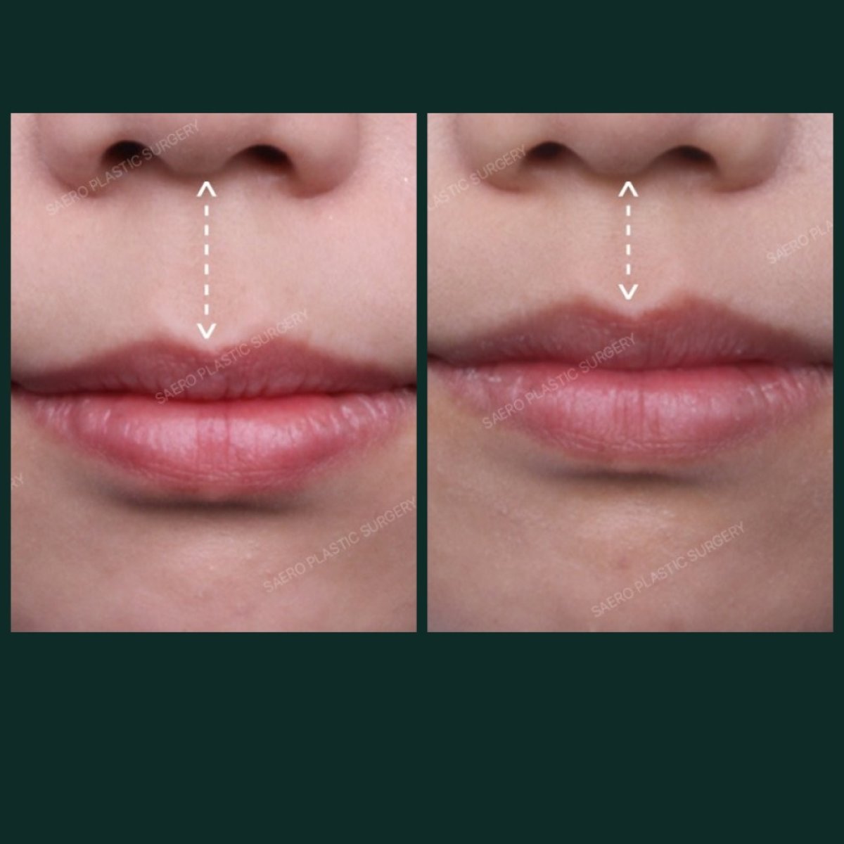 نتائج قبل وبعد رفع الشفاه في SAERO Plastic Surgery، تحسين شكل الشفة العليا